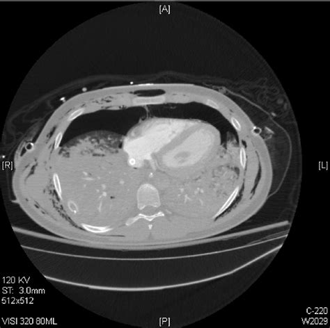 Cross Sectional Chest Ct Scan Depicting Bilateral Pulmonary Contusions