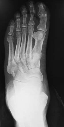 Bipartite Hallux Sesamoid Radiology Case Radiopaedia Org