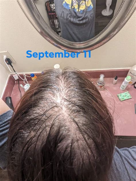Mielle rosemary oil update : r/FemaleHairLoss