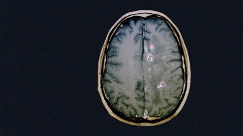 Neurocysticercosis Definition Symptoms And Treatment