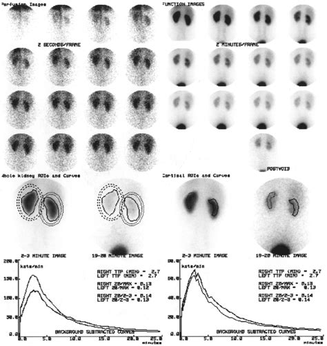 MAG3 renogram in an individual with normal kidneys. As well as showing... | Download Scientific ...