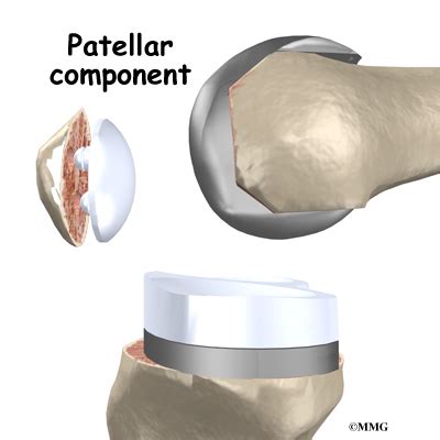 Artificial Joint Replacement of the Knee - eOrthopod.com