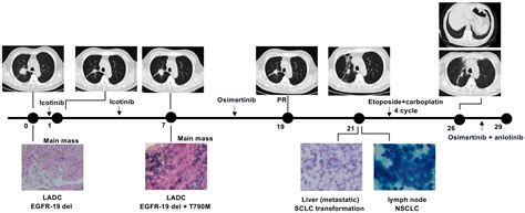 Frontiers Clinical And Molecular Profiling Of Egfr Mutant Lung