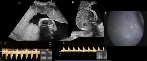 Monochorionic Diamniotic Twin Pregnancies American Journal Of