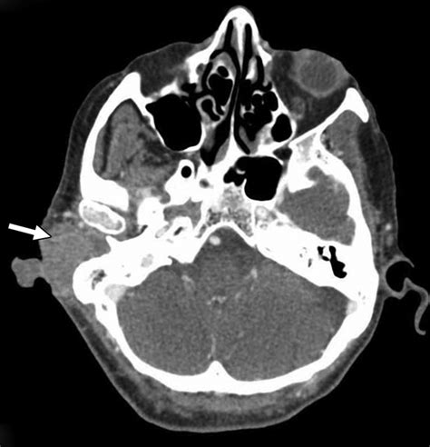 Dual Energy Ct Applications In Head And Neck Imaging Ajr