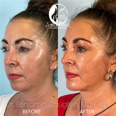 Morpheus Buccal Fat Removal Jawline Sculpting Chin Implant Fat