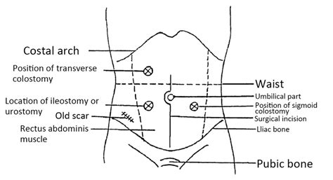 Common locations of enterostomy. | Download Scientific Diagram