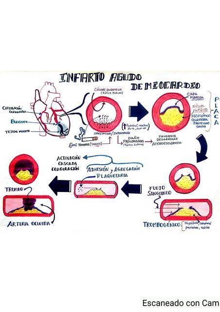 Infarto Agudo De Miocardio Fisiopatolog A Lafijamed Udocz