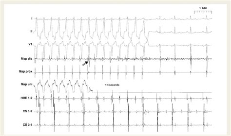 Stepwise Automated Remote Controlled Catheter Navigation To The Right Download Scientific