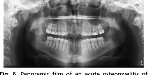 Alveolar Osteitis Radiograph