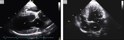 Combined Interventional Procedure And Cardiopulmonary Bypass Surgery In