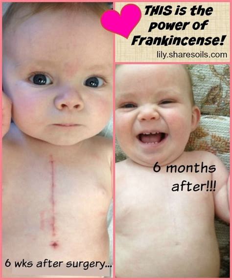 Open Heart Surgery Scar Baby - Goimages Radio