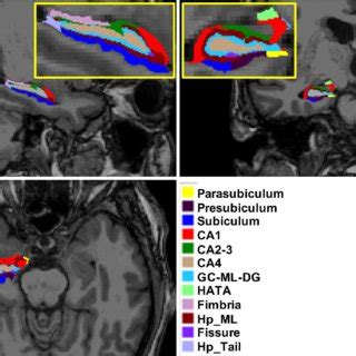 Illustration Of The Hippocampal Subfield Segmentations In Sagittal Top