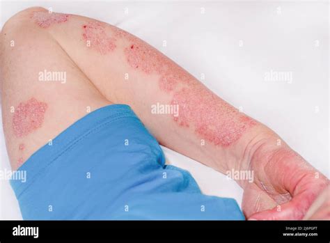 Psoriasis On Arms