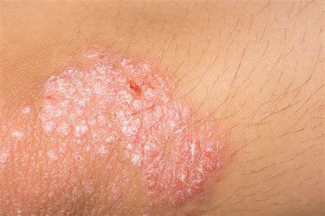 Generalized Pustular Psoriasis Confers Higher Disease Burden Than