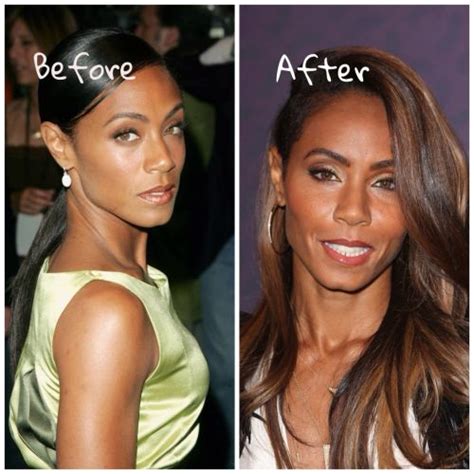 Jada Pinkett Smith Plastic Surgery: Cheek Implants, Facelift & Botox