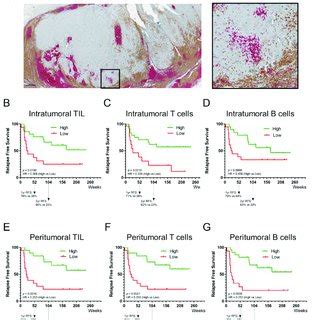 Prognostic Value Of Tumor Infiltrating Lymphocytes A Representative