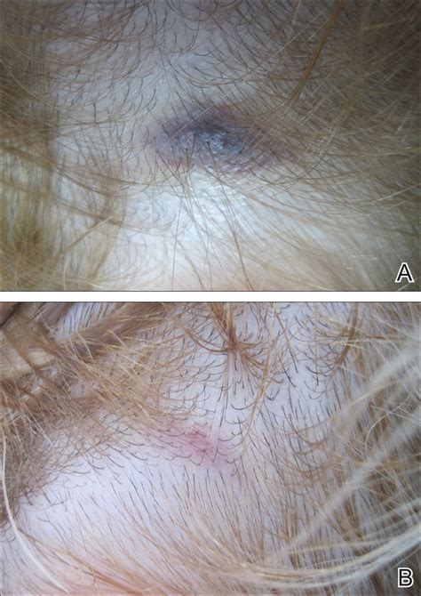 Autoimmune Progesterone Dermatitis Presenting With Purpura | MDedge ...