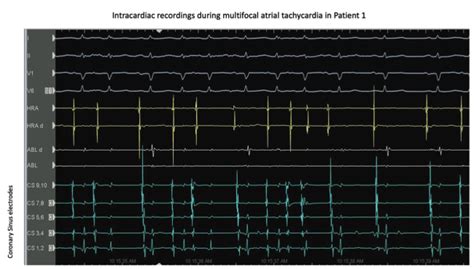 Targeted Ablation Of Multifocal Atrial Tachycardia Ep Lab Digest