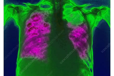 Pneumocystis Pneumonia Pcp X Ray Stock Image C038 9058 Science Photo Library