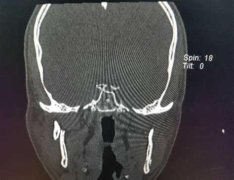 Coronal View Of Ct Scan Showing Right Mandibular Sub Condylar Fracture