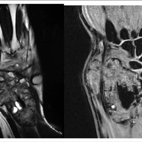 Shows The Plain Radiographs Of A Years Old Girl With Gct Sacrum