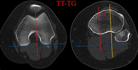 Tt Tg The Posterior Condylar Line Blue Line Was Drawn Tangential To