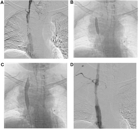 A Nearly Total Occlusion Of Svc With Thrombus Formation Near Internal