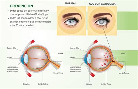 Glaucoma ¡conózcalo Y Prevéngalo