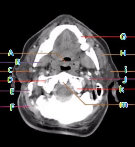 Ct Neck Axial Cross Sectional Anatomy Flashcards Quizlet