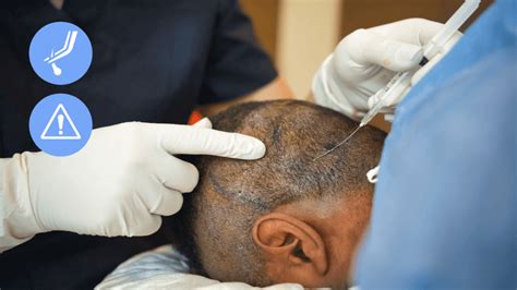 11 Side Effects and Minor Setbacks of a Hair Transplant Surgery