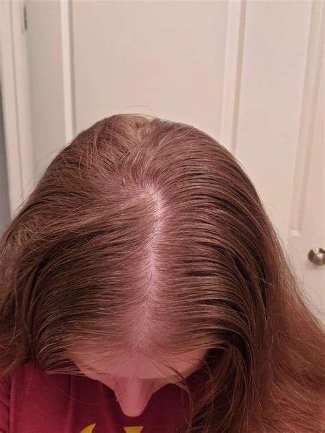 Minoxidil Itching Femalehairloss