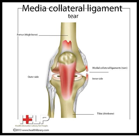 Media Collateral Ligament Tear Ligament Tear, Skeletal, Anatomy, Thighs ...