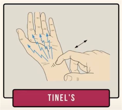 Upper Extremity Syndromes Traumas Flashcards Quizlet