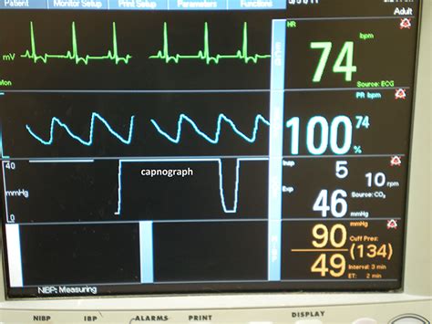 Anesthetic Monitoring Interpreting The Readings Clinicians Brief