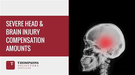 Severe Head And Brain Injury Compensation Amounts Youtube