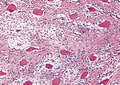 Russell's Blog: myositis ossificans histology