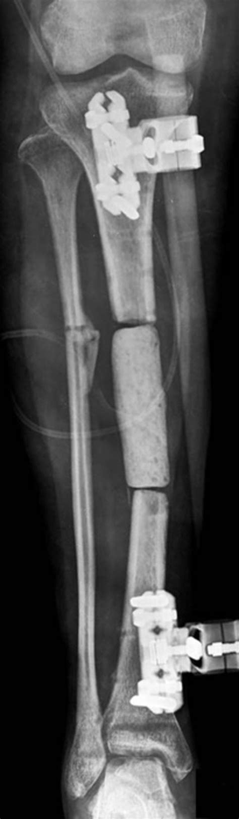 Bone Transport With An External Fixator And A Locking Plate For