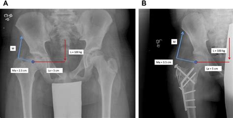 Treatment of Coxa Brevis | Musculoskeletal Key