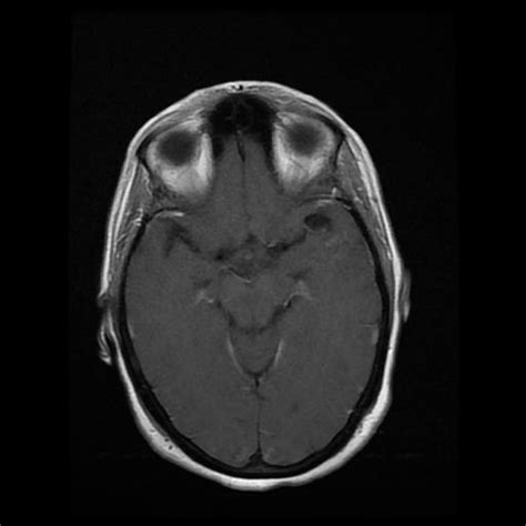 Cerebral Cavernous Malformation Image Radiopaedia Org