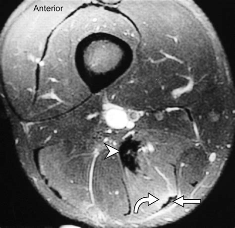 Hamstring Anatomy Mri