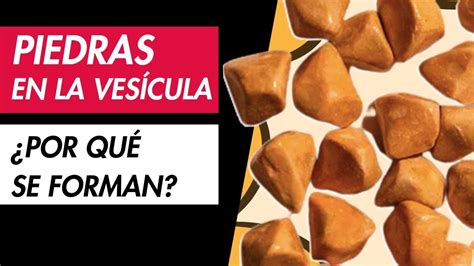 Alerta Descubre cómo se forman las piedras en la vesícula YouTube