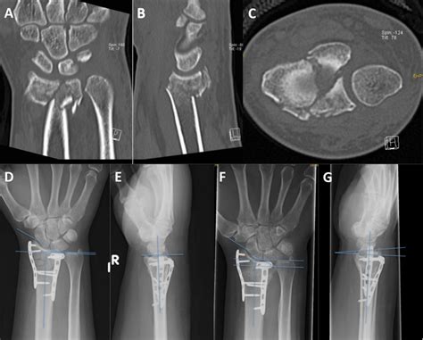 Example For The Dorsal Locking Plate Group Computed Tomography Ct Of Download Scientific