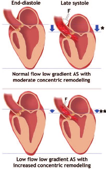 Significant Aortic Stenosis With Preserved Ejection Fraction And Low Download Scientific