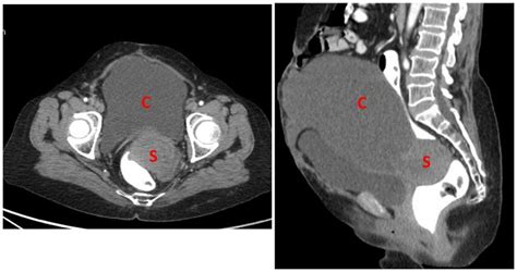 Ct Scan Image Showing Large Pelvic Mass With Cystic C And Small Deep