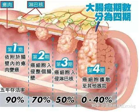 直肠癌保肛中心：直肠癌二期治愈率高不高？能活多久？ 知乎