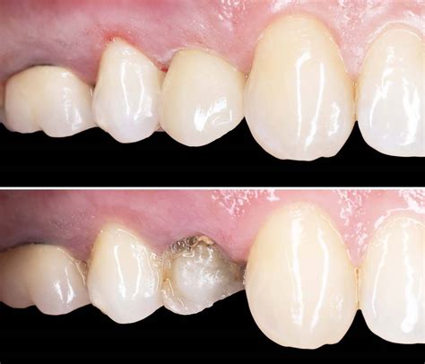 dental crown before and after - Amazing Smiles