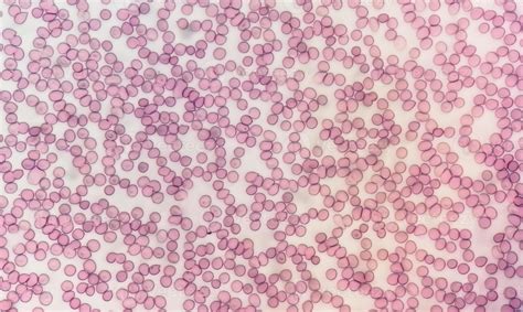 Microscopic view of hematological stained slide. thrombocytopenia