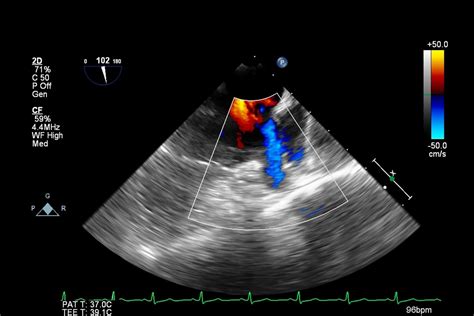 Transesophageal Echocardiogram