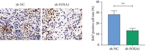 Silencing Of Foxa Inhibits Cc Cell Growth And Reduces Chemoresistance